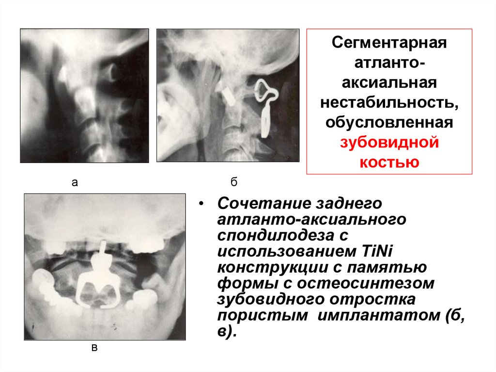 Атланто аксиальное сочленение