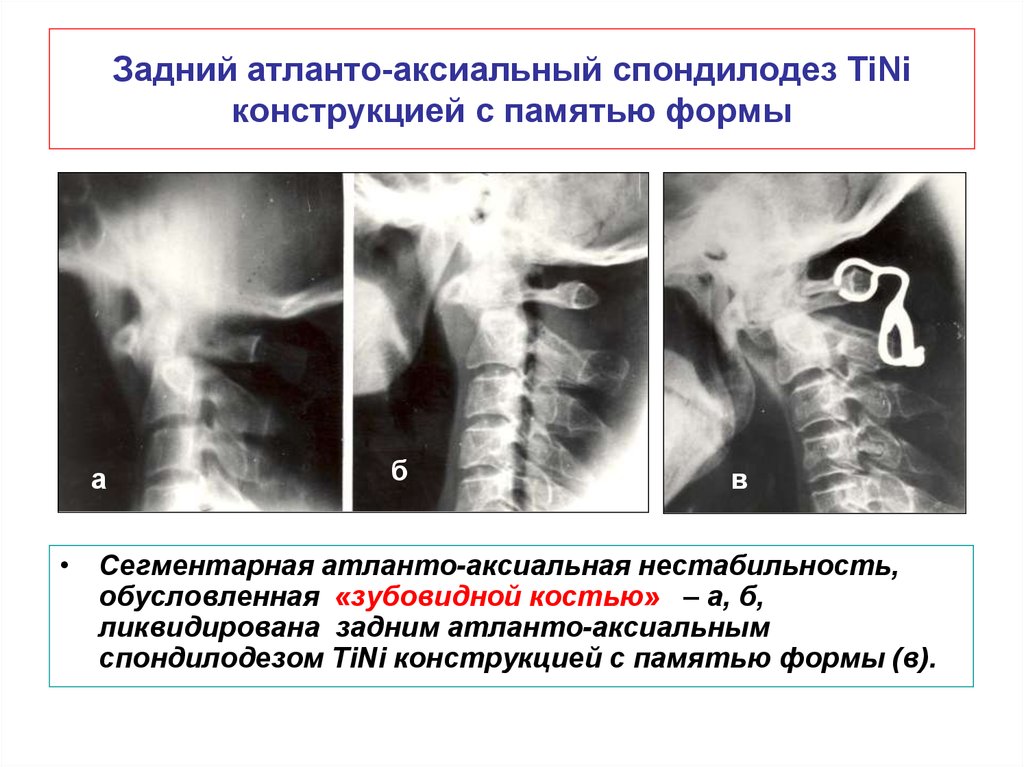 Атланто аксиальное сочленение