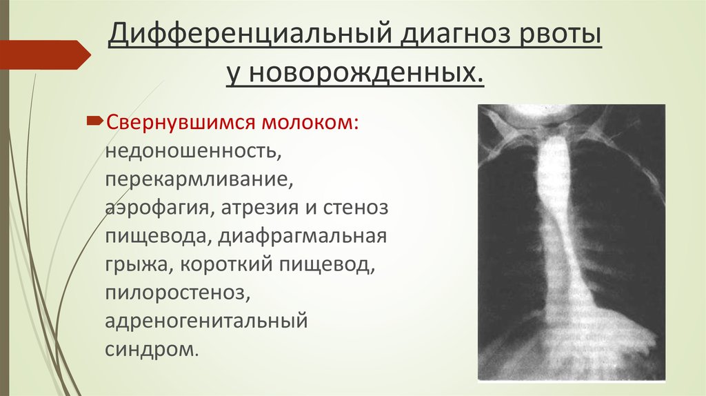 Рвота диагноз. Дифференциальная диагностика адреногенитального синдрома. Пилоростеноз и пилороспазм, адреногенитальный синдром. Атрезия пищевода дифференциальная диагностика. Дифференциальный диагноз рвота.