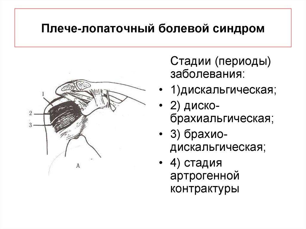 Шейный синдром. Лопаточный болевой синдром. Шейный рефлекторный синдром. Рефлекторный болевой синдром при остеохондрозе. Лопаточно плечевой синдром.