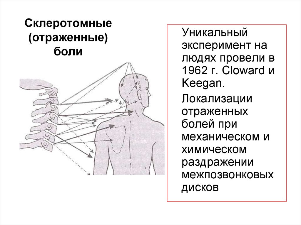 Рефлекторные боли. Склеротомные боли. Нейрометамерная иннервация. Зоны отраженных болей. Склеротом это неврология.