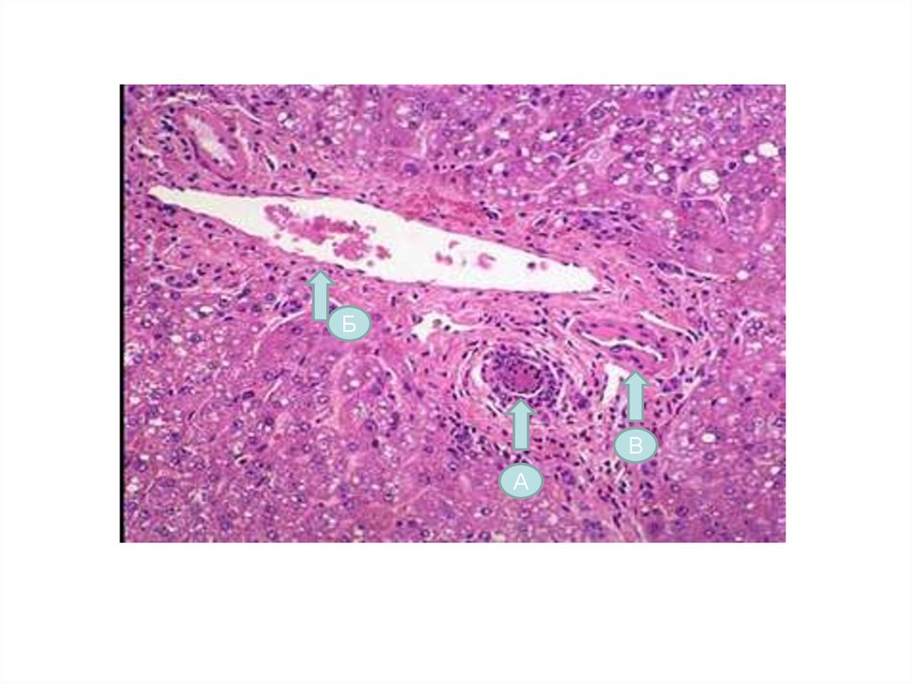 Острый гепатит c. Гепатит печени патанатомия. Гепатит микропрепарат патанатомия. Вирусный гепатит микропрепарат. Острый вирусный гепатит микропрепарат.