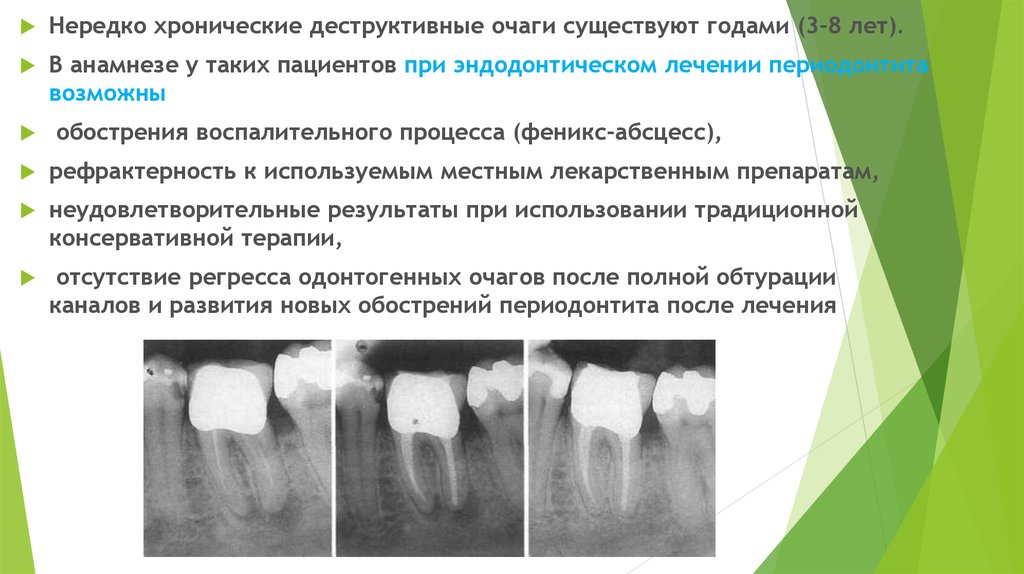 Ошибки и осложнения при лечении периодонтита