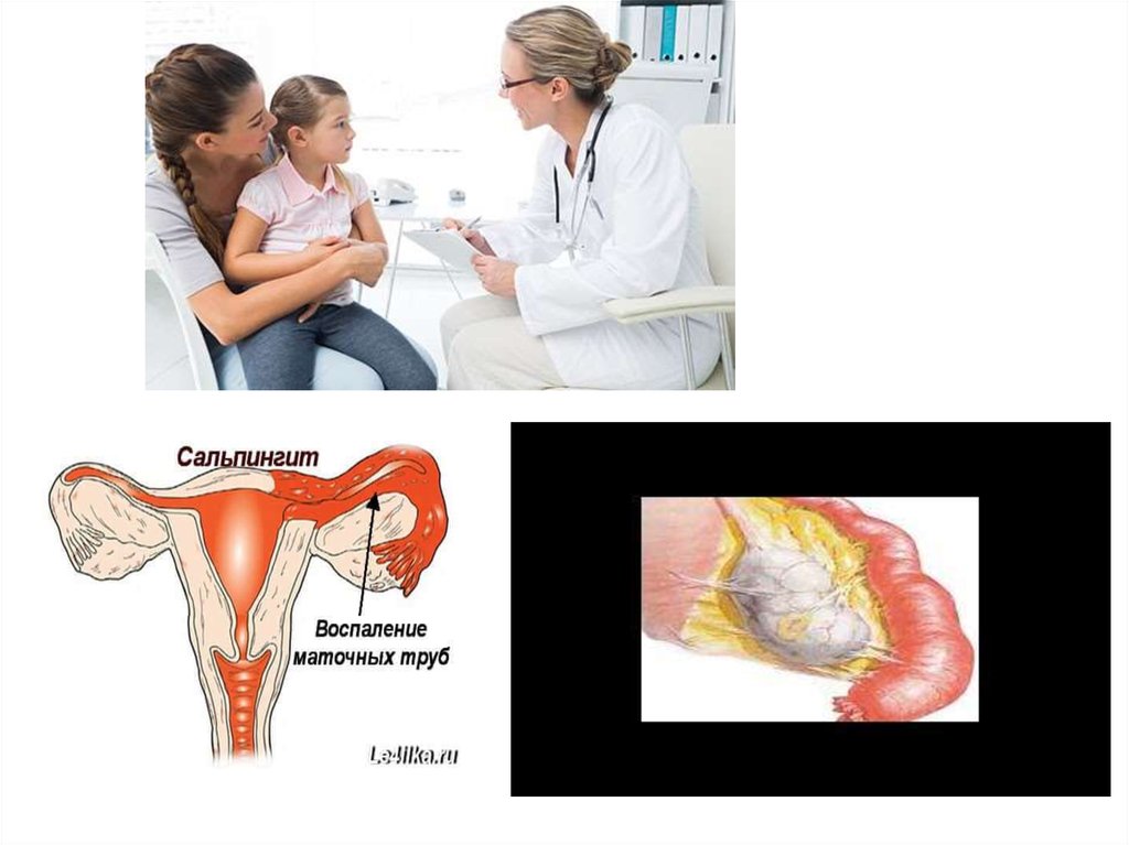 Сальпингит что это такое у женщин. Острый Гнойный сальпингит. Гнойный сальпингит лапароскопия. Сальпингит маточной трубы. Хронический воспалительный процесс в маточных трубах.
