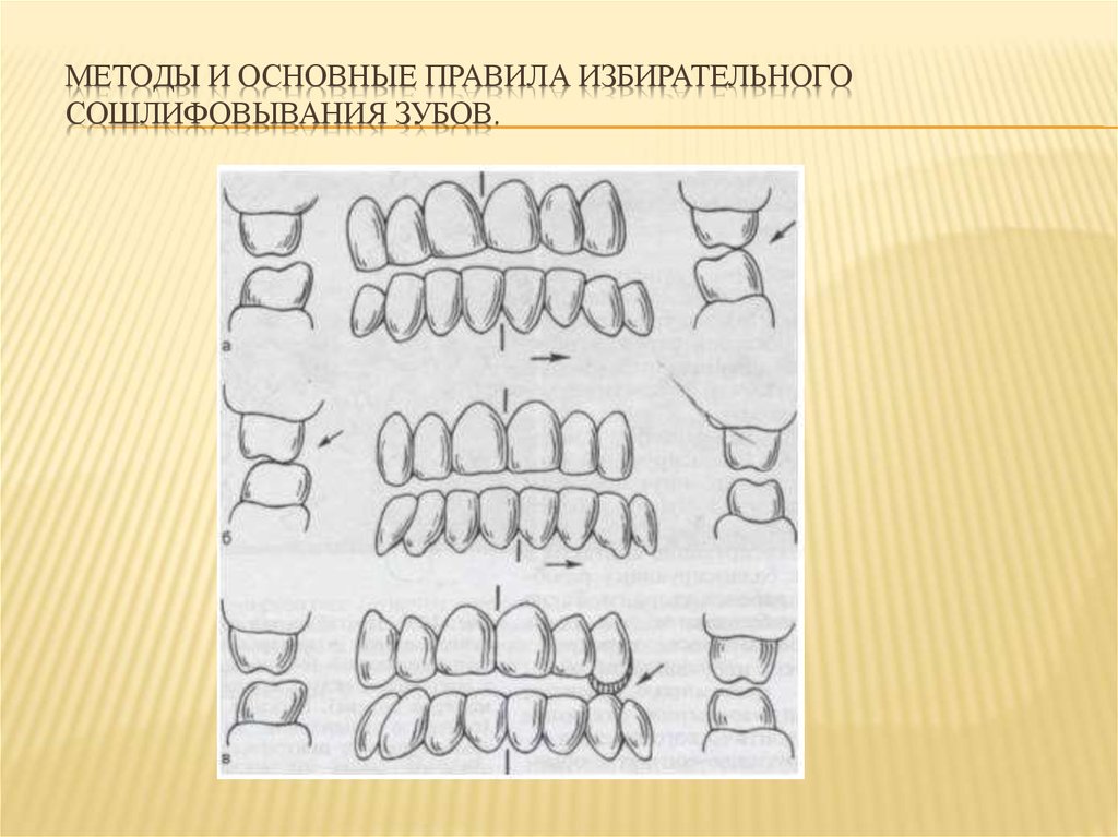 Избирательное пришлифовывание зубов презентация