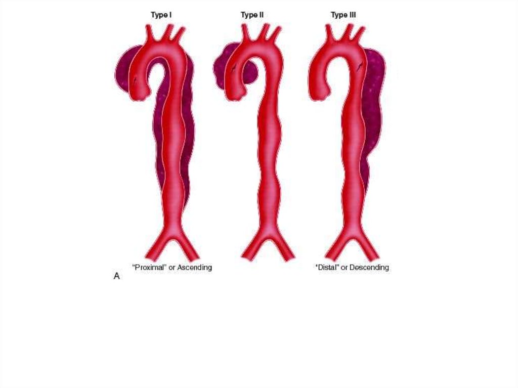 Расслоение аорты презентация