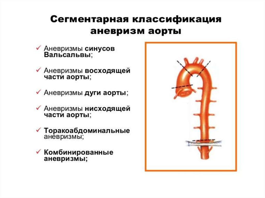 Аневризма синуса. Классификация аневризм восходящего отдела аорты. Расширение восходящего отдела аорты классификация. Классификация аневризмы брюшного отдела аорты. Аневризмы восходящего отдела аорты классификация.