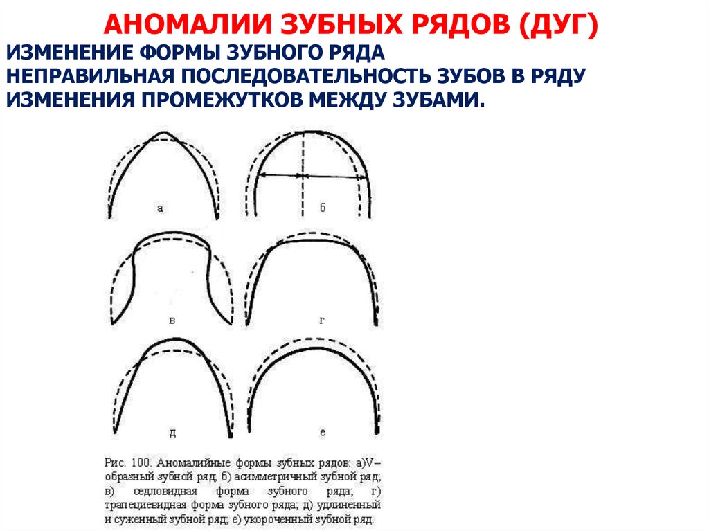 Виды дуг. Классификация аномалий формы зубных рядов. Зубная дуга параболической формы. Формы зубных дуг верхней и нижней челюсти. Форма дуги верхней челюсти.