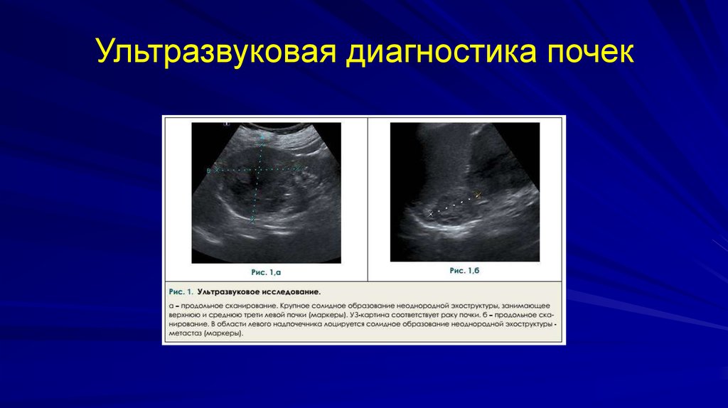 Диагностика почек. Ультразвуковая диагностика почек. Инструментальные методы диагностики почек. Методы обследования в нефрологии. Ультразвуковая диагностика заболевания почек.