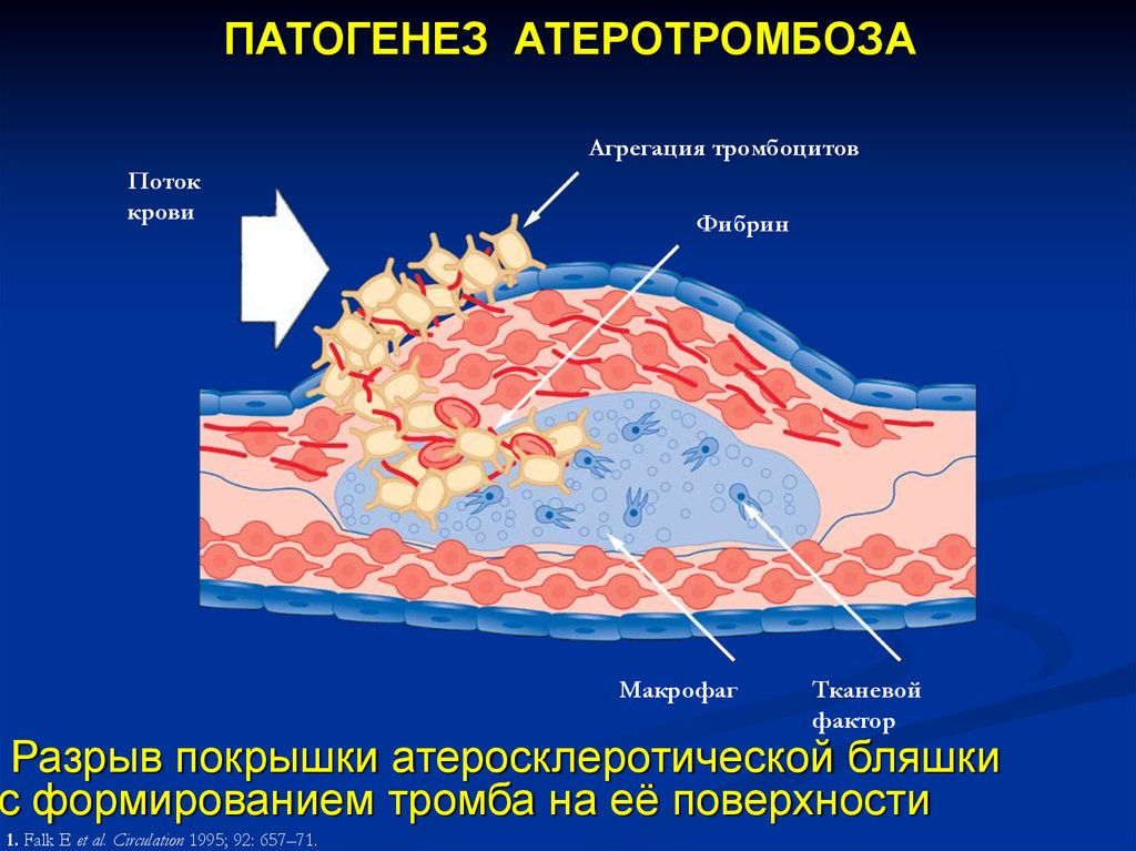 Разрыв бляшки. Разрыв атеросклеротической бляшки патогенез. Разрыв капсулы атеросклеротической бляшки. Образование атеросклеротической бляшки патогенез.