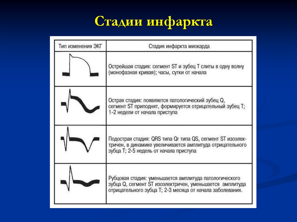 Стадии инфаркта миокарда. Признаком острейшей стадии инфаркта миокарда является. Признаки острейшей фазы инфаркта миокарда является. Острая стадия инфаркта миокарда характеризуется. ЭКГ признаки острейшей стадии инфаркта миокарда.