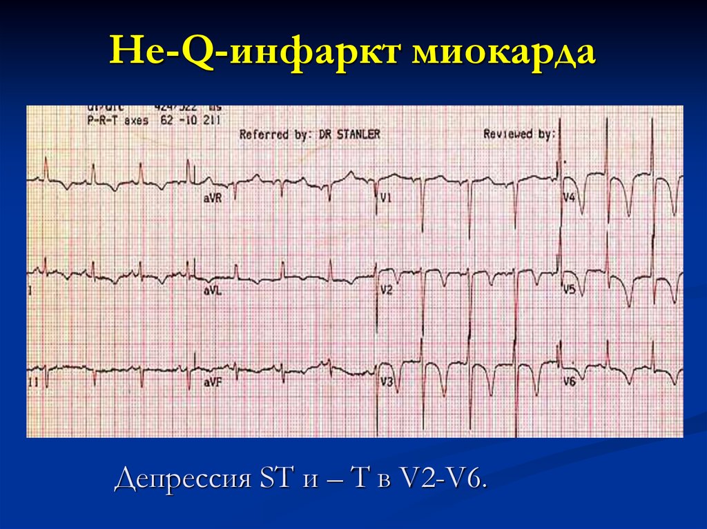 Как выглядит инфаркт на кардиограмме фото