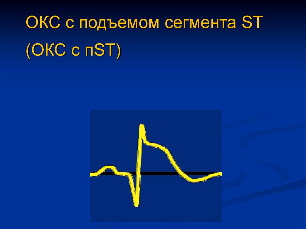 Без подъема. Острый коронарный синдром с подъемом St. Окс c подъемом сегмента St. Окс c подъемом сегмента St ЭКГ. Окс c подъемом сегмента St клиника.