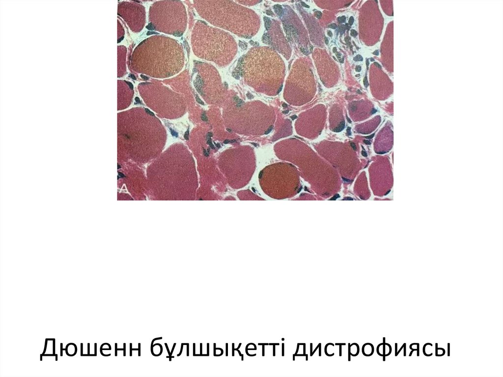 Дюшенн бұлшықетті дистрофиясы