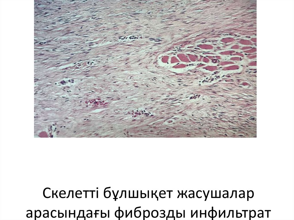 Скелетті бұлшықет жасушалар арасындағы фиброзды инфильтрат