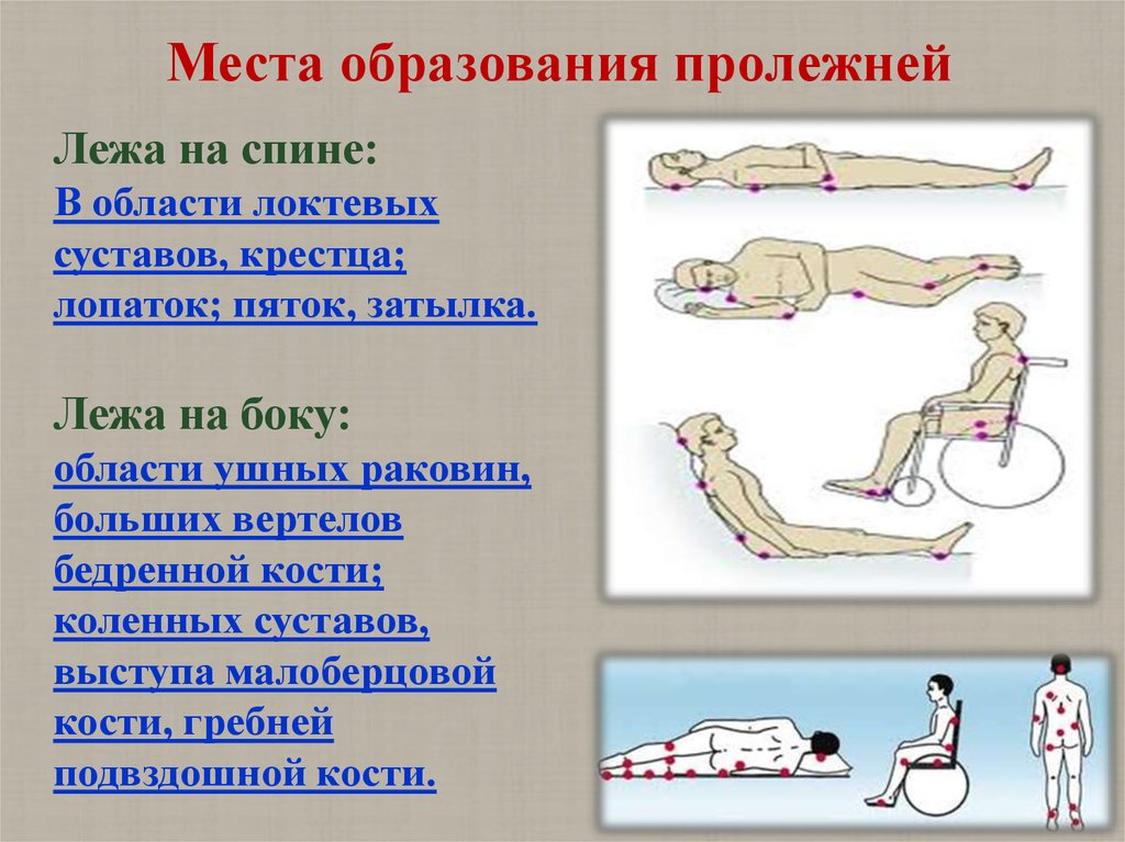 Образование пролежней. Места образования пролежней. Месьа образование пролежги. Места возможного образования пролежней. Местоьобоазования пролежнений.