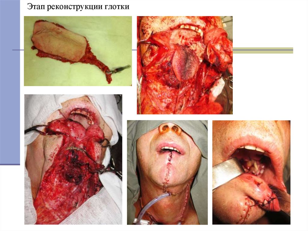 Этап реконструкции глотки