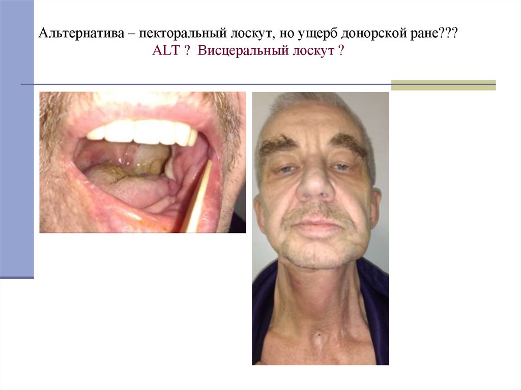 Альтернатива – пекторальный лоскут, но ущерб донорской ране??? ALT ? Висцеральный лоскут ?