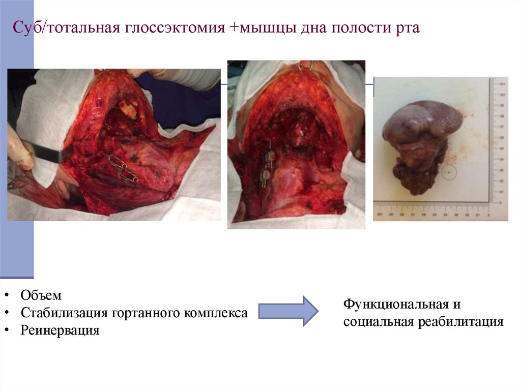 Суб/тотальная глоссэктомия +мышцы дна полости рта