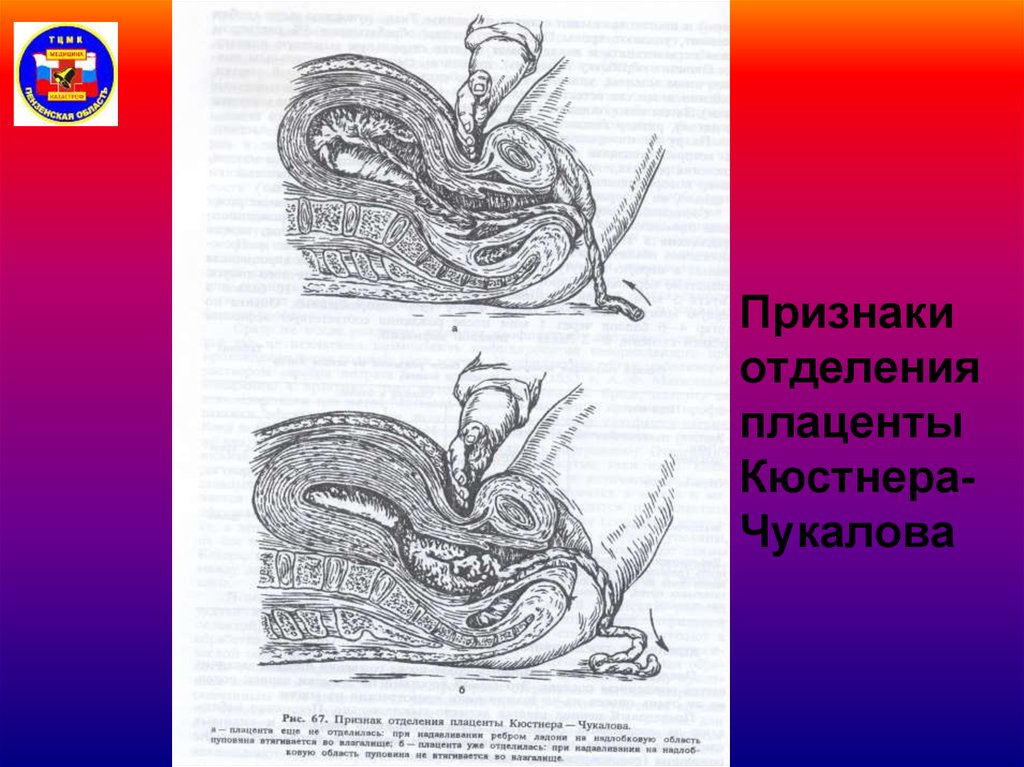 Признаки отделения плаценты. Признак отделения последа Кюстнера-Чукалова. Признак отделения плаценты Кюстнера-Чукалова. Признак Шредера Альфельда и Кюстнера-Чукалова. Признак Кюстнера Чукалова признаки отделения последа.