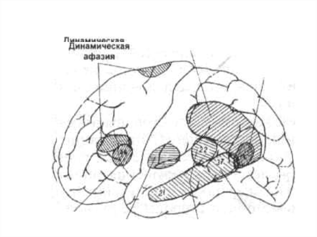 Динамическая афазия. Очаг поражения при динамической афазии. Динамическая моторная афазия. Динамическая афазия зона поражения. Динамическая афазия локализация очага поражения.