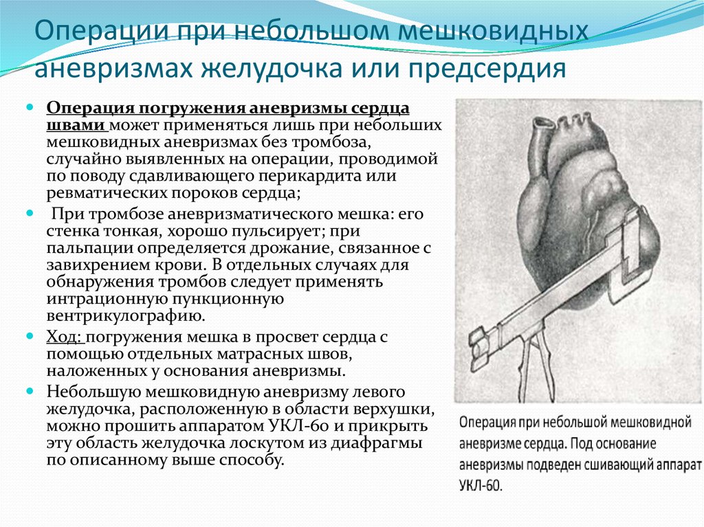 Картине истинной аневризмы в области верхушки миокарда левого желудочка соответствует