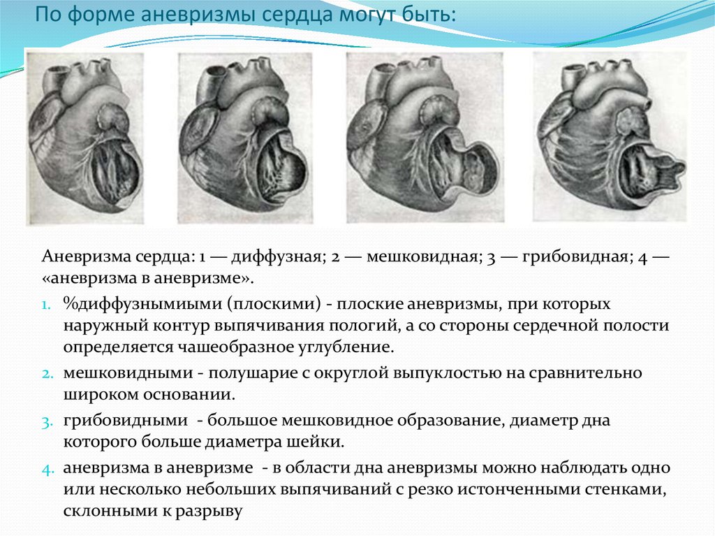 Картине истинной аневризмы в области верхушки миокарда левого желудочка соответствует