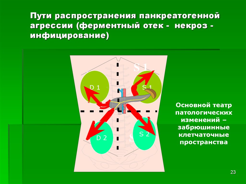 Схема распространения патологических процессов по брюшной полости