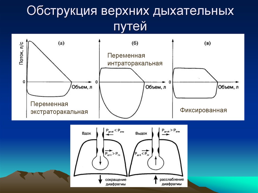 Обструкция дыхательных путей. Обструкция верхних дыхательных путей. Обтурация верхних дыхательных путей. Виды обструкции верхних дыхательных путей. Непроходимость верхних дыхательных путей.