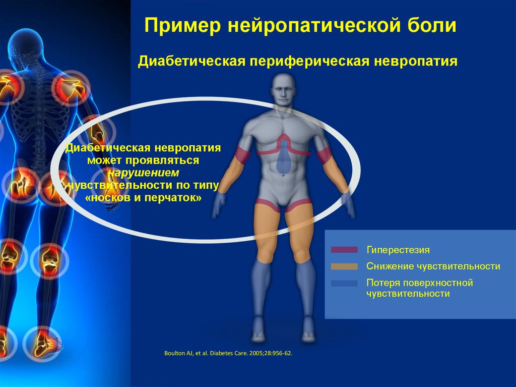 Примеры нейропатической боли Повреждение локтевого нерва вследствие перелома кости