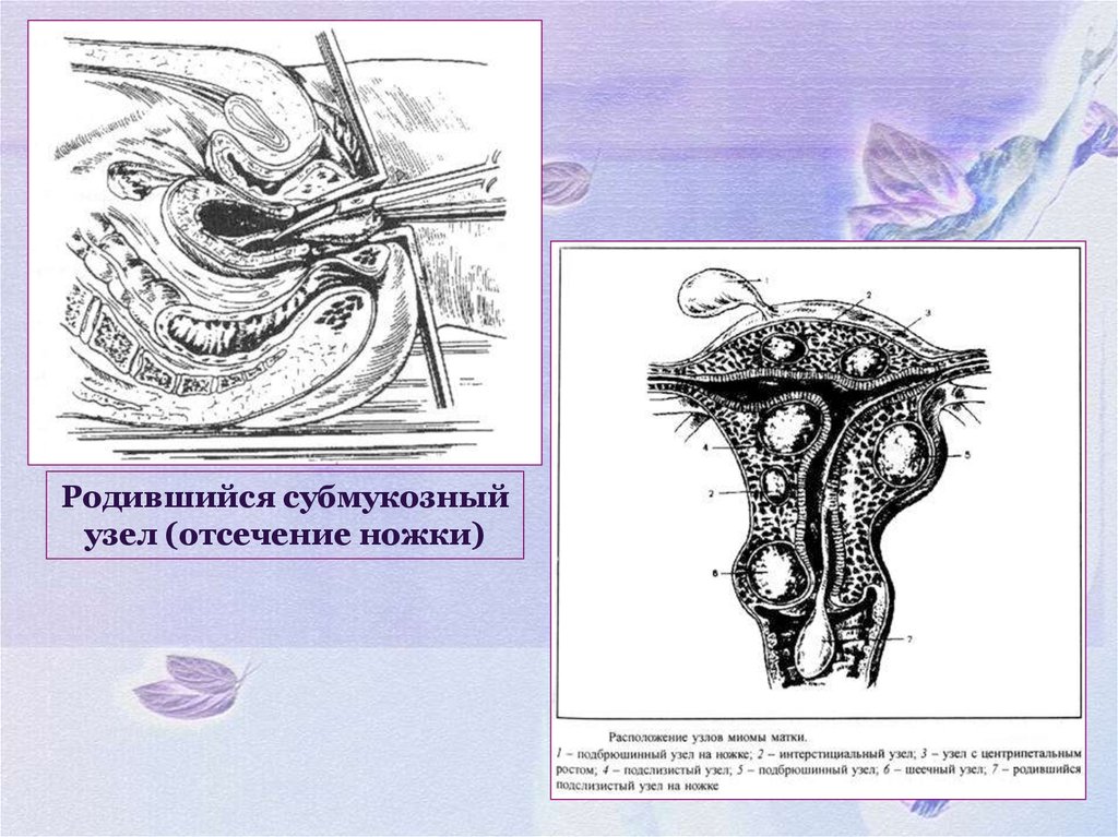 Удаляющий узел. Экспульсия миоматозного узла. Множественная миома с субмукозным ростом узла. Миоматозный узел рождение. Рождение субмукозного миоматозного узла.
