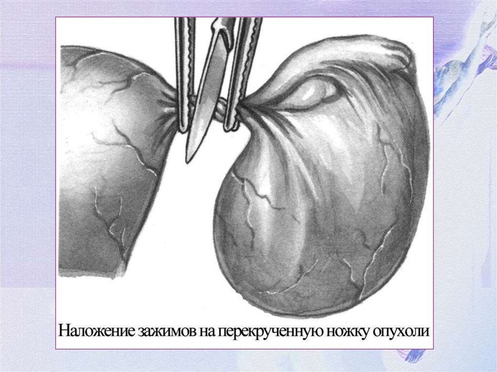 Перекрут яичка карта вызова