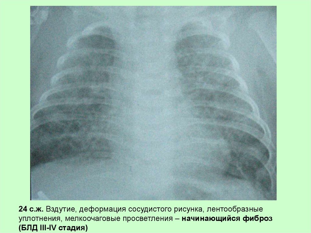 Фиброз у детей. Острая деформация сосудистого рисунка легких у ребенка. Вздутие легких у детей. У ребёнка блд и фиброз легких.