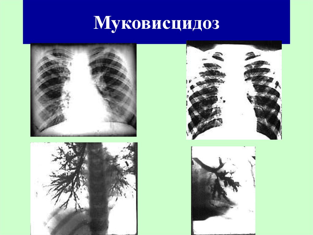 Муковисцидоз рентгенологическая картина