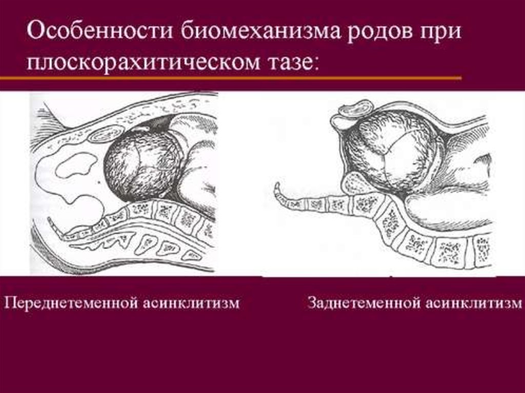 Особенности родов. Биомеханизм общеравномерносуженный таз. Плоскорахитический таз биомеханизм. Плоскорахитический таз родоразрешение. Биомеханизм при общеравномерносуженном тазе.