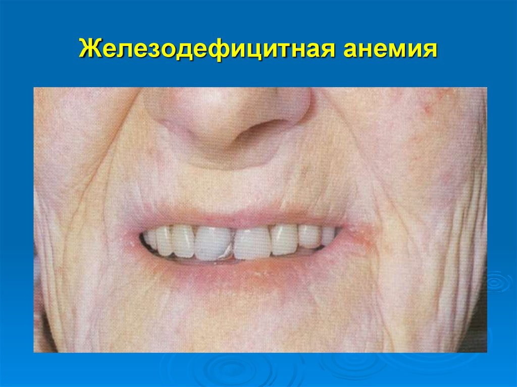 Фото анемия железодефицитная анемия