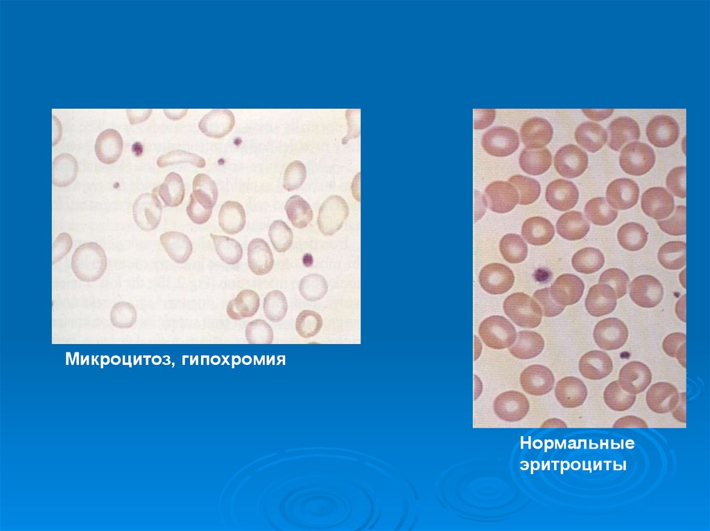Гипохромия и гиперхромия. Гипохромная анемия эритроциты. Гипохромия и микроцитоз эритроцитов. Гипохромия жда.