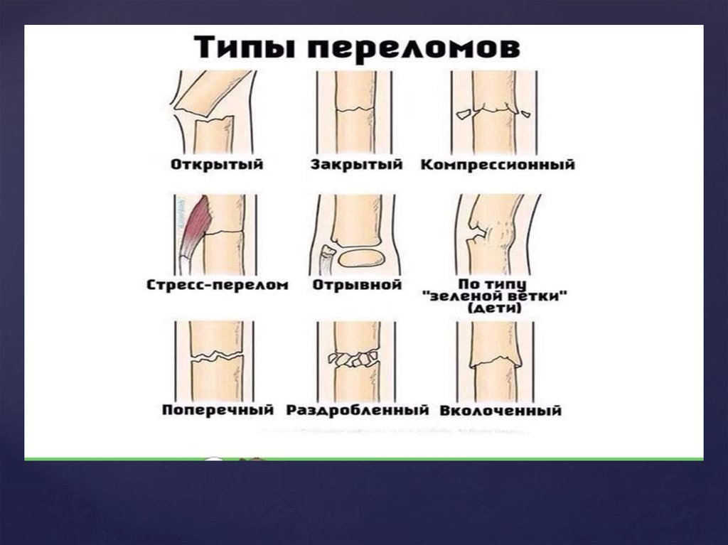 Трещина это перелом. Полный и частичный перелом. Трещина и перелом кости разница.