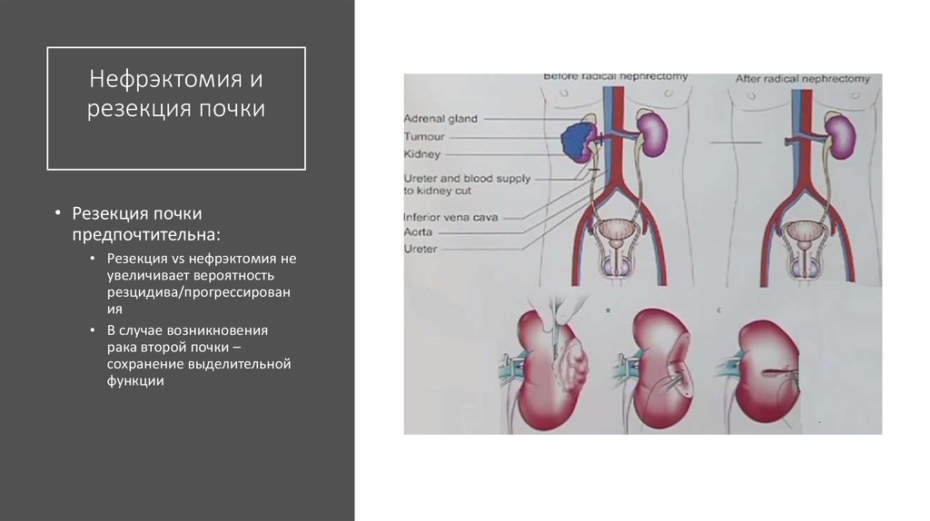 Нефрэктомия. Нефрэктомия резекция почки. Основные этапы нефрэктомии.