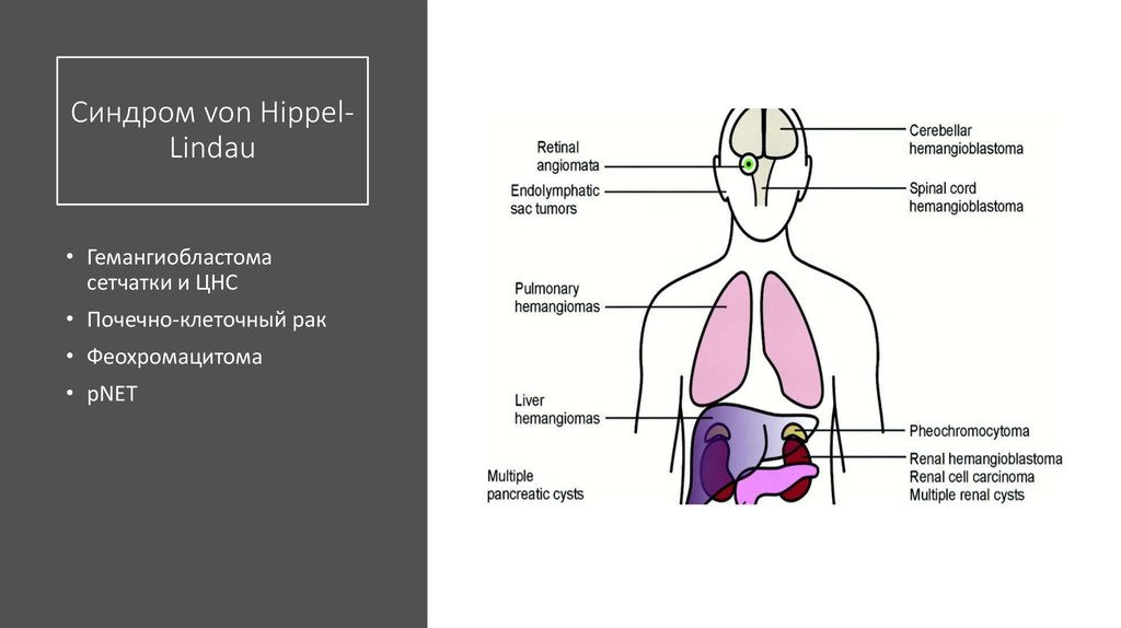 Синдром гиппеля линдау презентация