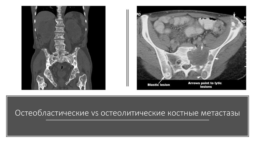 Метастазы в кости при раке предстательной. Остеобластические метастазы в кости на кт. Остеобластические метастазы в кости таза на кт. Метастазы в кости таза кт. Остеолитические метастазы кт.