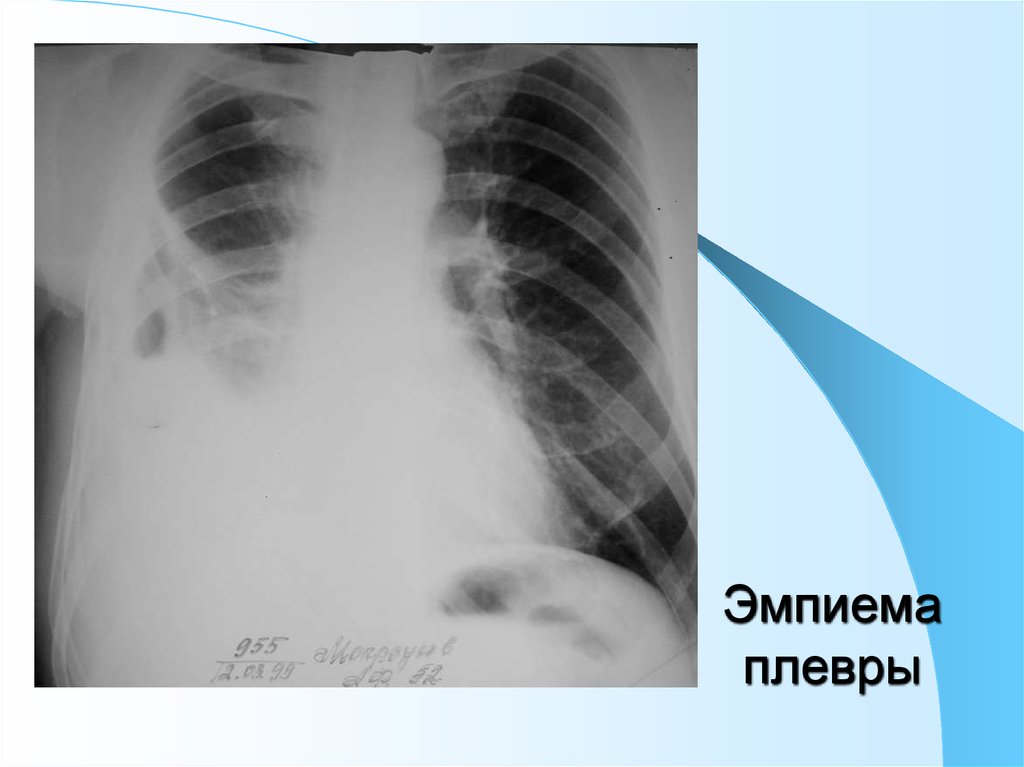 Эмпиема легкого. Эмпиема легких рентген. Тотальная эмпиема плевры рентген. Хроническая эмпиема плевры рентген. Острая эмпиема плевры рентген.