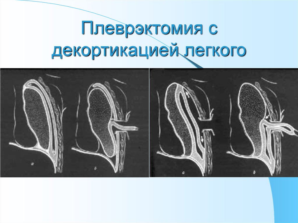 Плеврэктомия. Операция Делорма декортикация легкого. Плеврэктомия с декортикацией легкого.