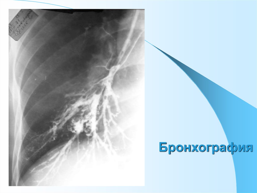 Бронхография. Бронхиальная астма бронхография. Бронхография абсцесс лёгкого. Контрастная бронхография.