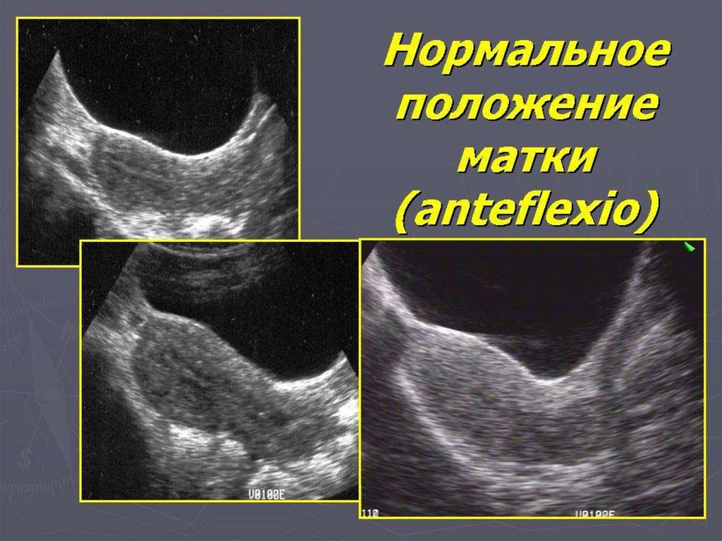 Положение тела матки. Положение матки на УЗИ. Расположение матки на УЗИ.