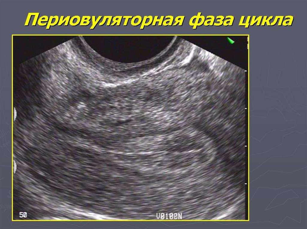 Эндометрия 23. Периовуляторный эндометрий на УЗИ. Периовуляторная фаза эндометрия. Эндометрий фаза периовуляторная.