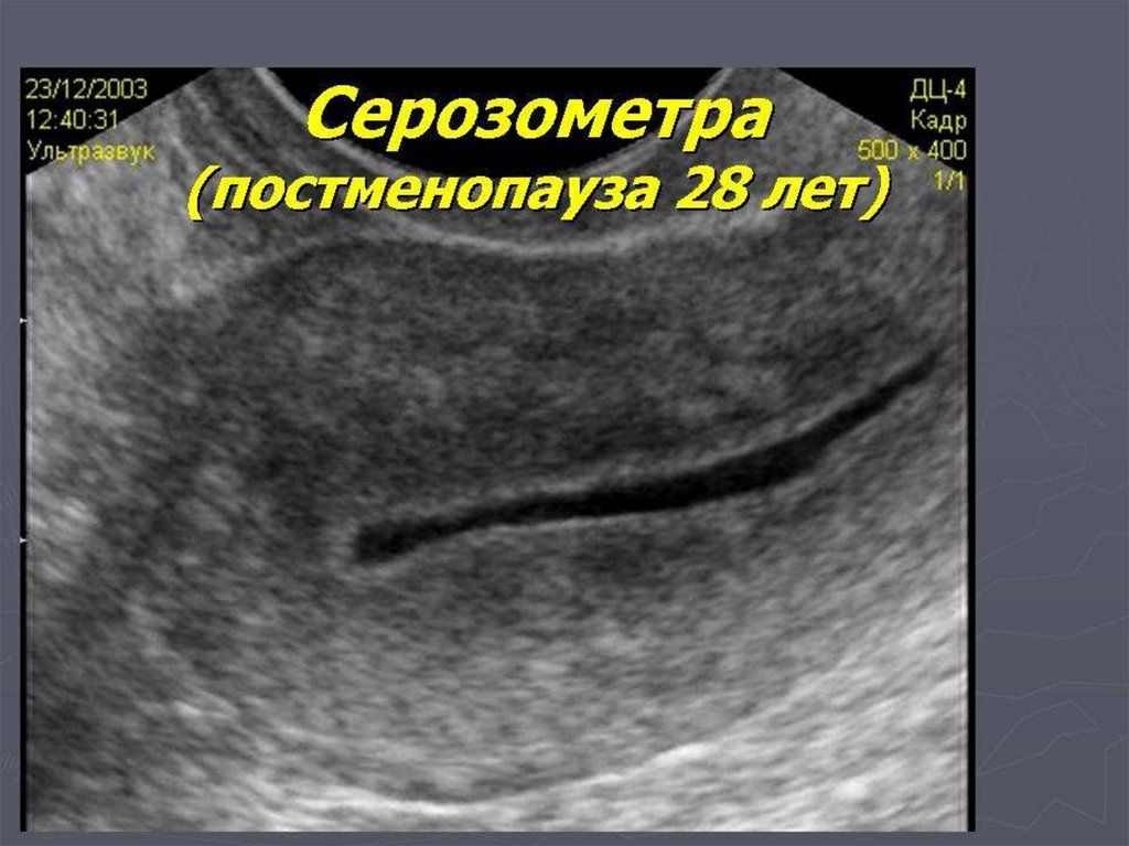 Серозометра после 60. Ультразвуковая анатомия матки.