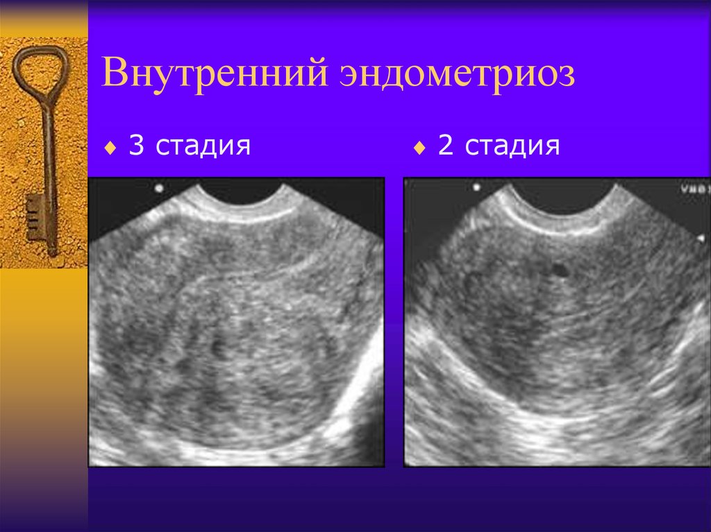 Как выглядит эндометриоз на узи в матке фото