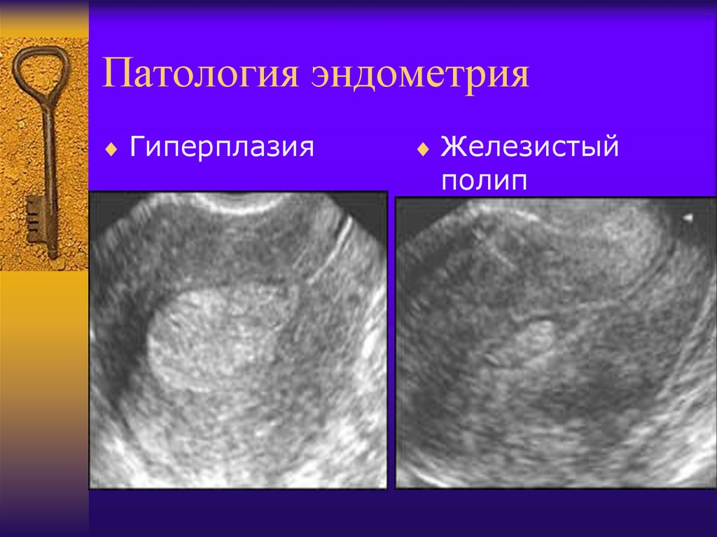 Эндометрия стенок матки. Гиперплазия эндометрия эндометрит. Патология эндометрия гиперплазия эндометрия. Гиперплазия эндометрия МФЯ. Патология эндометрия гиперплазия.