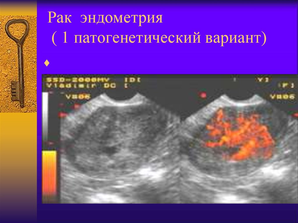Эндометрий 30. Гиперплазия эндометрия на УЗИ. Карцинома эндометрия на УЗИ.